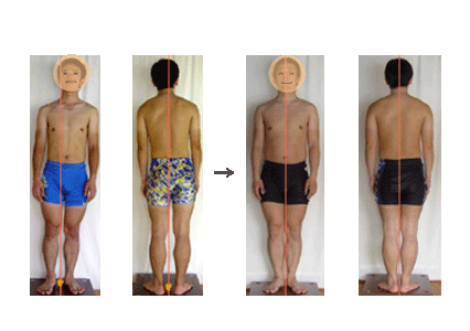 ◆Case 8: Poor posture due to eye trouble